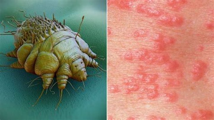 What do scabies look like?