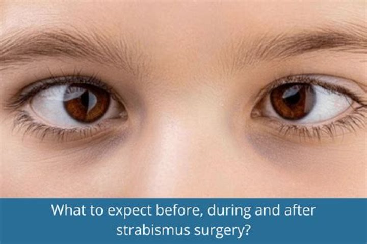 What doctor does strabismus surgery?