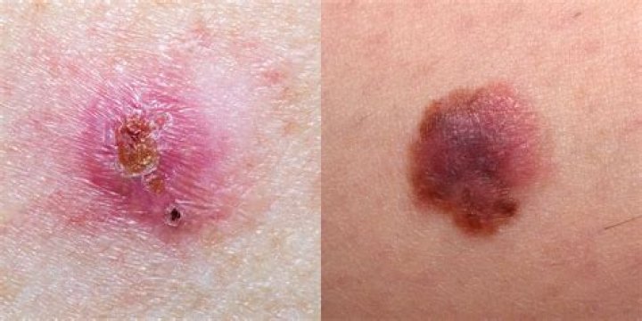 What does a cancerous scab look like?