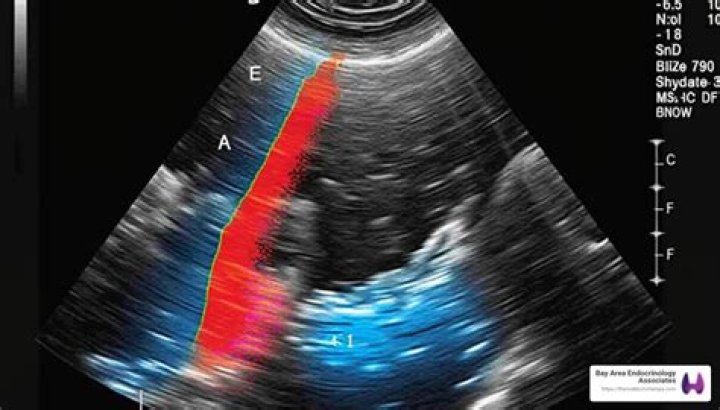 What does a dark mass on an ultrasound mean?