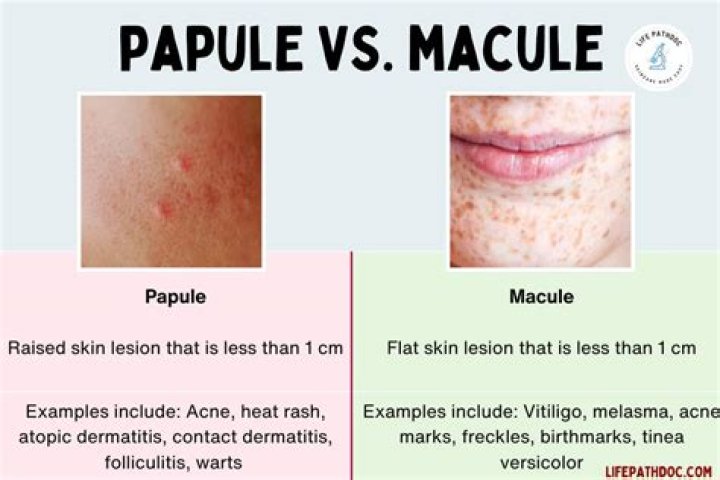 What does a macule look like?