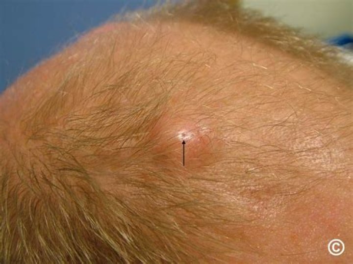 What does a pilar cyst look like?