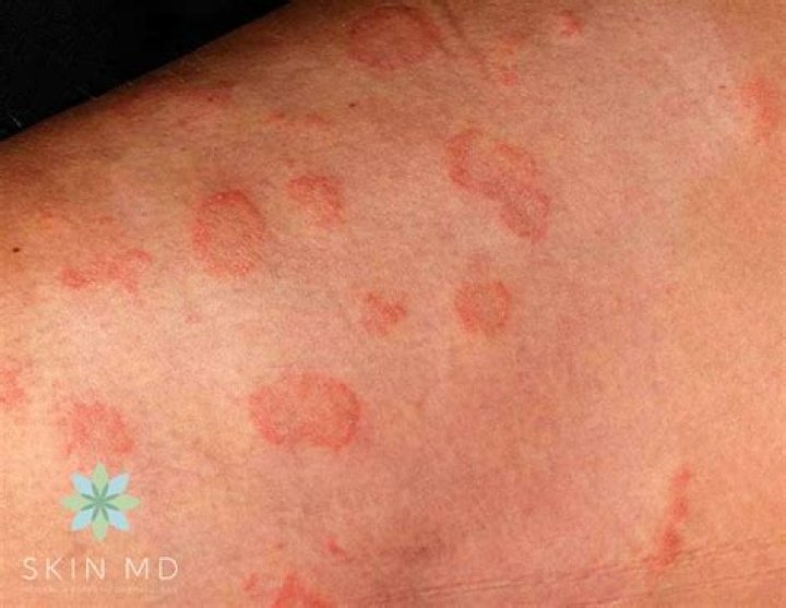 What does a skin fungal rash look like?