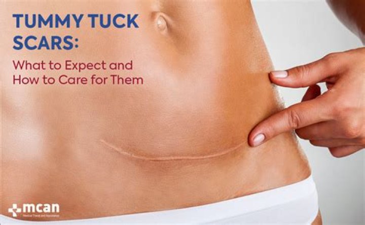 What does a tummy tuck scar look like?