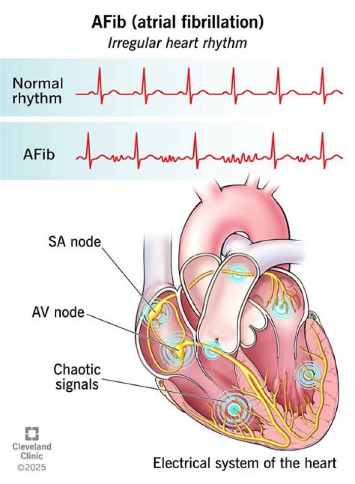 What does AFIB sound like?