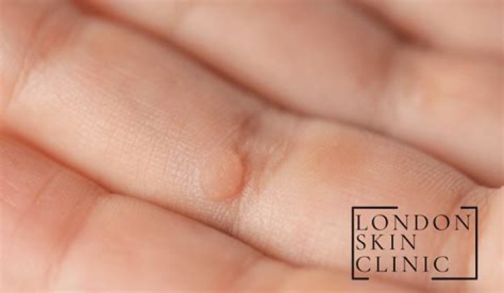 What does an early verruca look like?