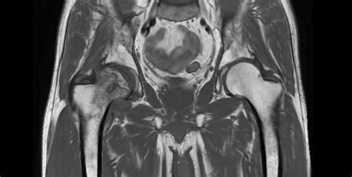 What does AVN look like on MRI?