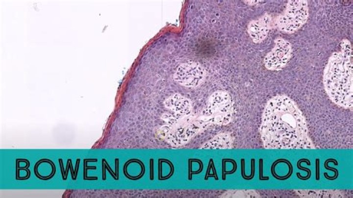What does bowenoid papulosis look like?