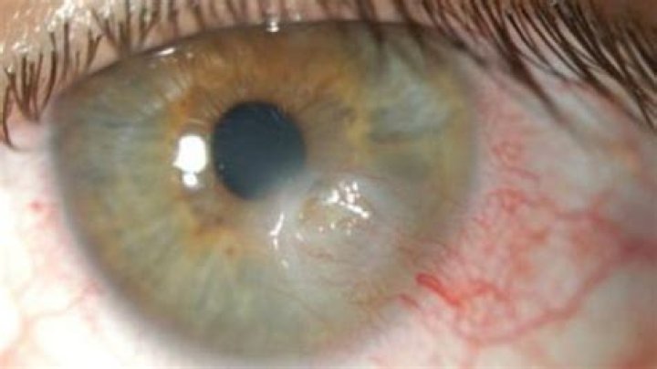 What does deidara have on his eye?