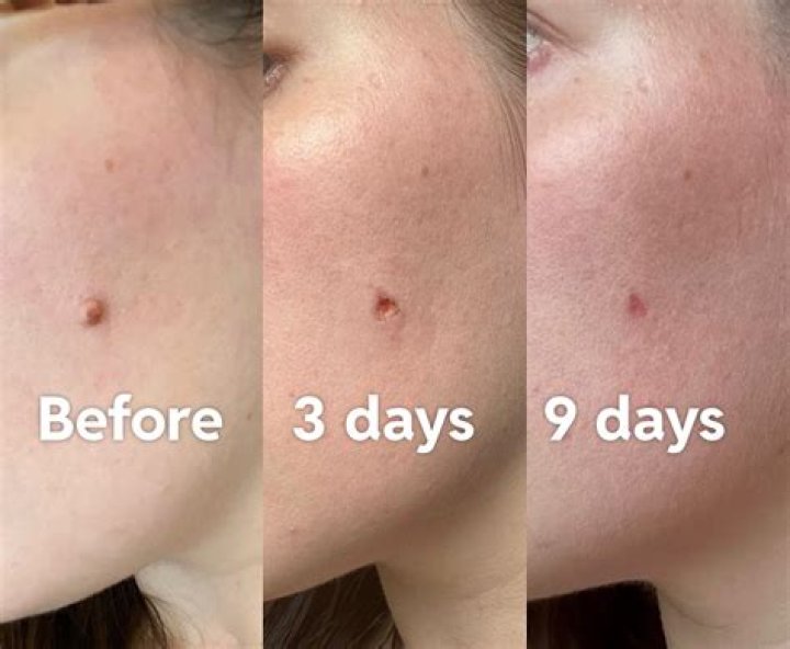 What does it look like after a mole is removed?