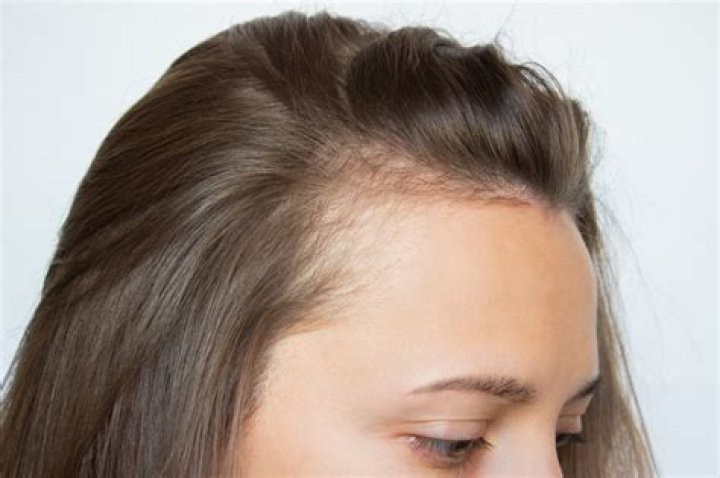 What does it mean if your hair is getting thinner?
