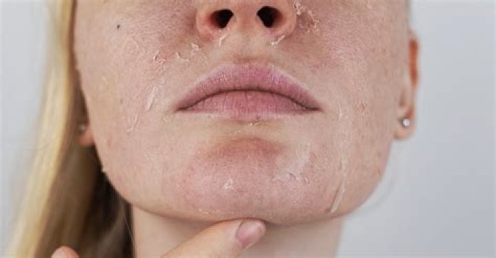 What does it mean when your skin turns white after using hydrogen peroxide?