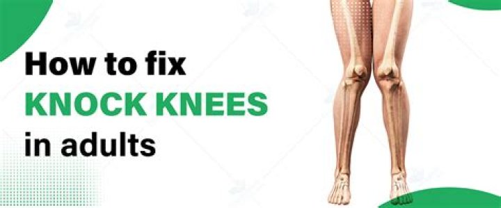 What does knock knees mean?