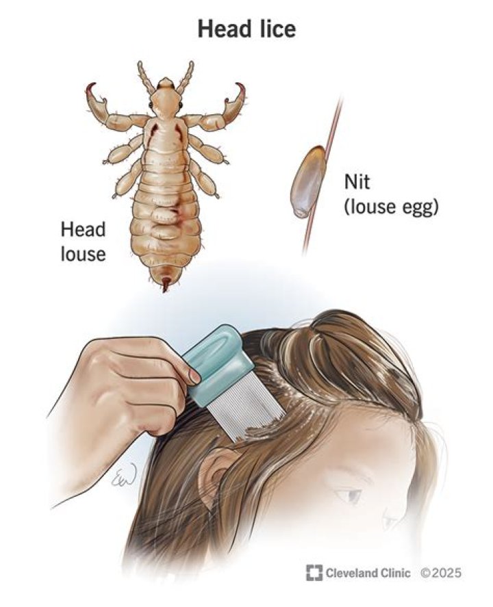 What does lice feel like?