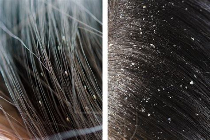 What does lice look like vs dandruff?