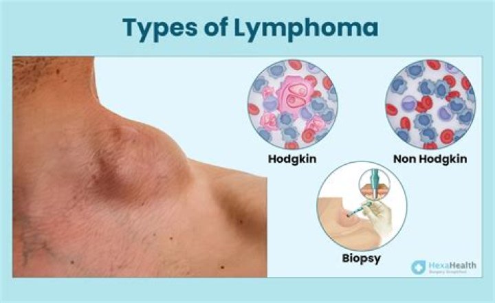 What does lymphoma in the neck feel like?