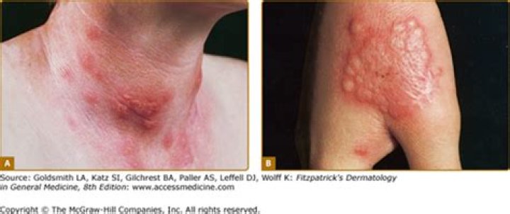 What does neutrophilic dermatosis look like?