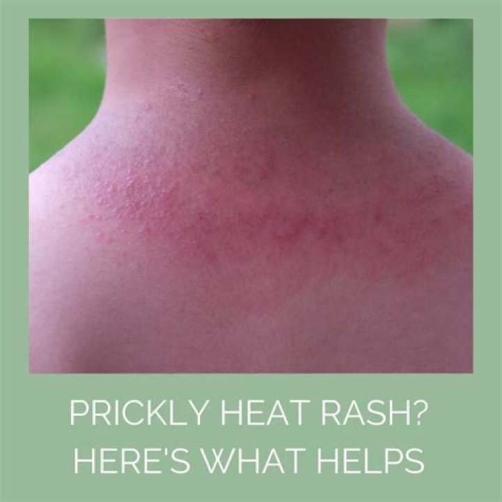 What does prickly heat rash look like?