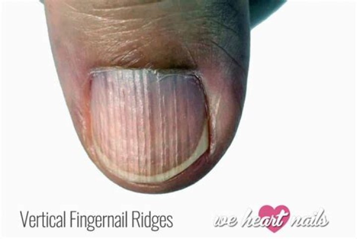 What does ridges in nails mean?