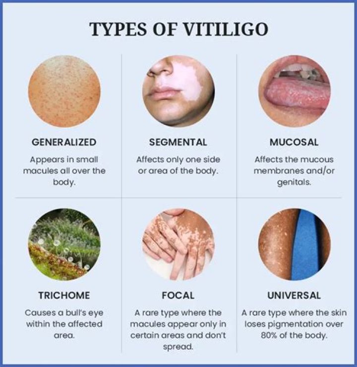 What does the beginning stages of vitiligo look like?