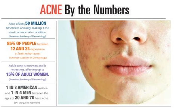 What ethnicity has the least acne?