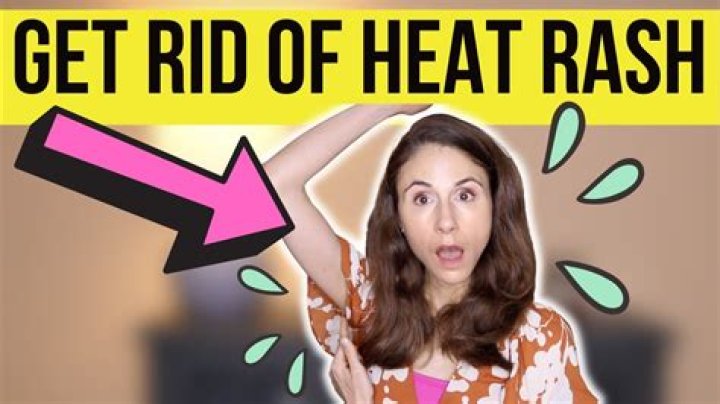 What gets rid of heat rash fast?