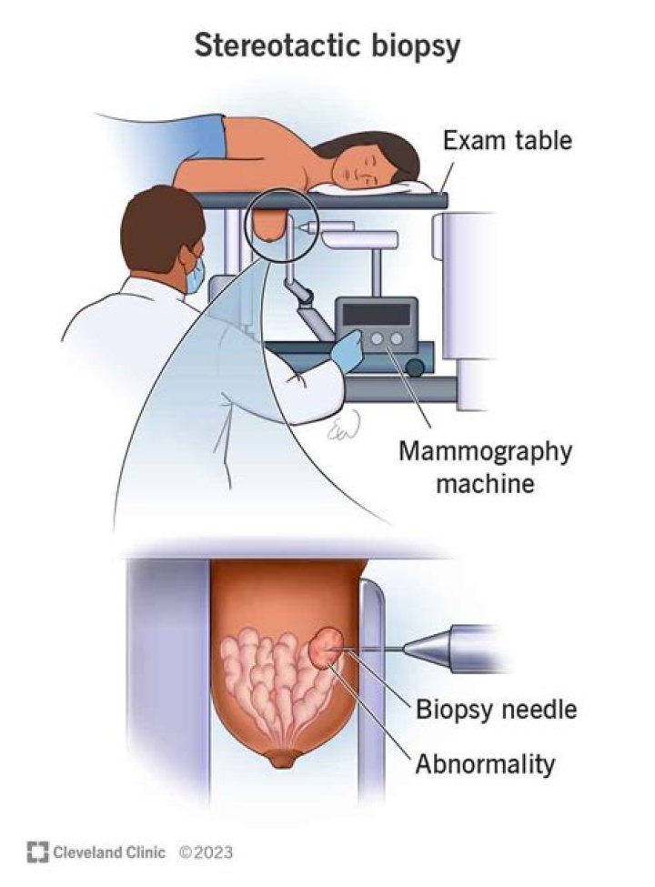 What happens after a biopsy?