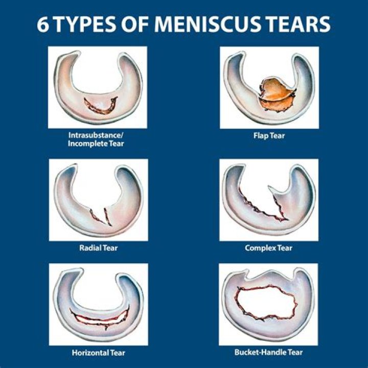 What happens if a torn meniscus goes untreated?