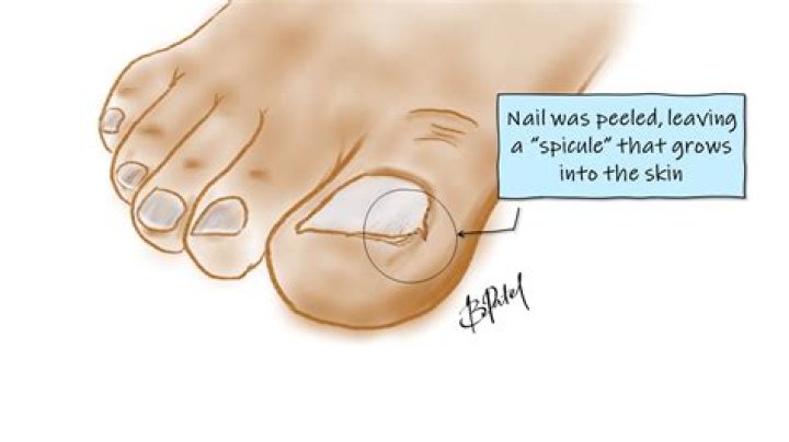 What happens if an ingrown toenail is left untreated?