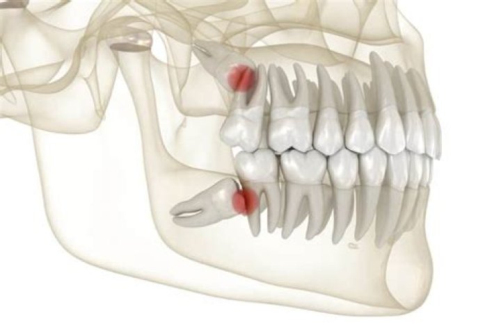 What happens if I don't get my wisdom teeth removed?