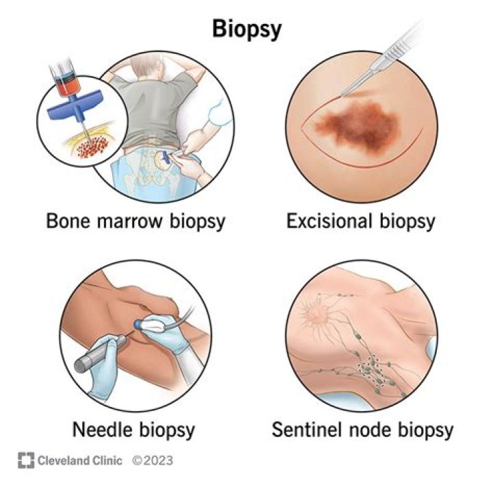 What happens if mole biopsy is positive?