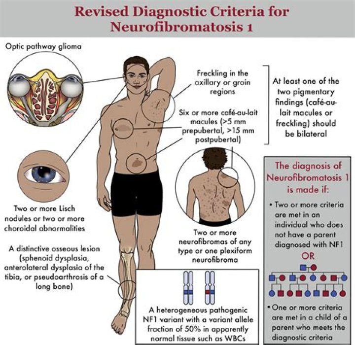 What happens if neurofibromatosis is left untreated?