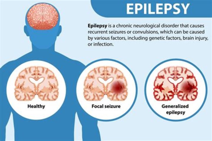 What happens in the brain of a person with epilepsy?