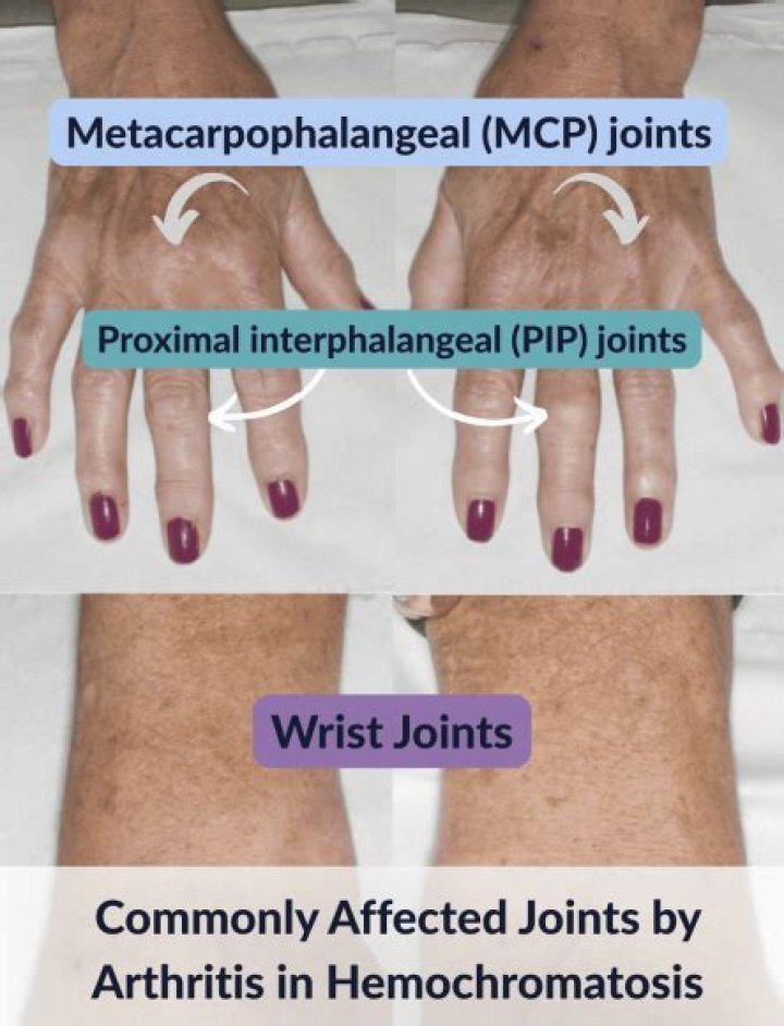 What helps joint pain from hemochromatosis?
