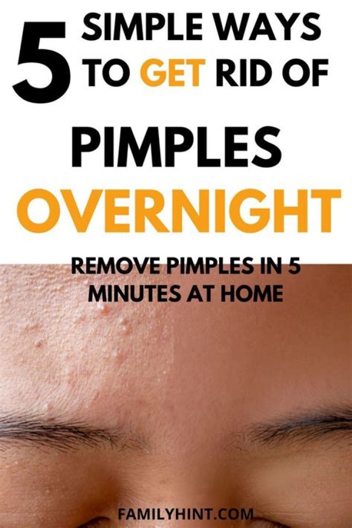 What home remedy gets rid of pimples overnight?