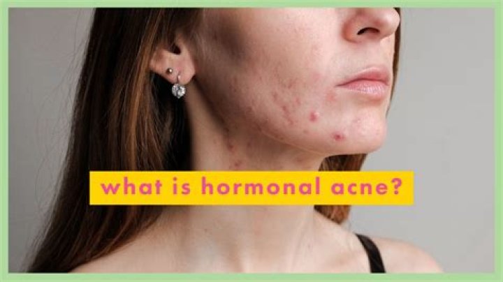 What hormone causes acne in females?