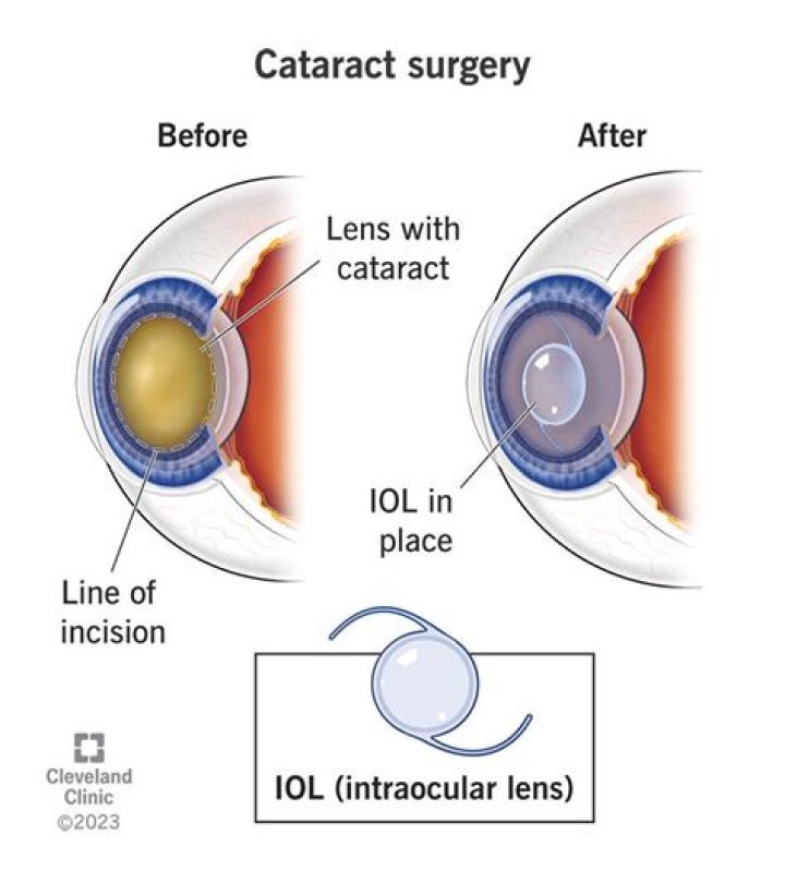 What if I sneeze during cataract surgery?