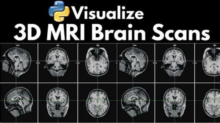 What is a 3D MRI?
