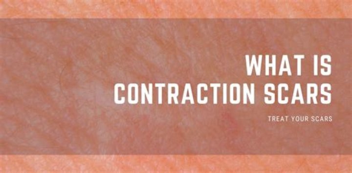 What is a contracture scar?