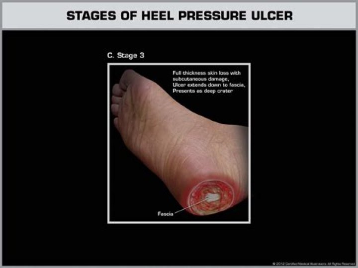 What is a Grade 3 pressure sore?