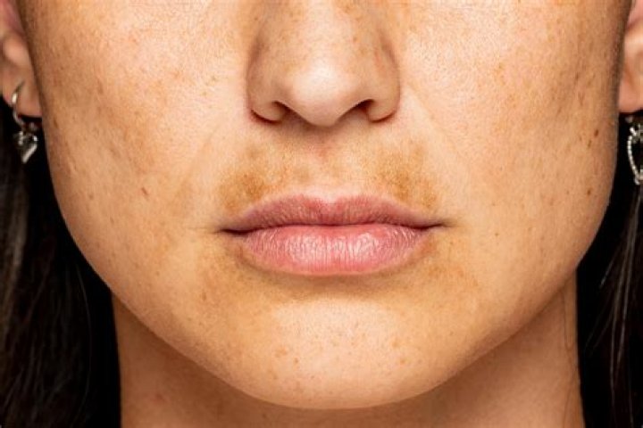 What is a Hyperpigmented scar?