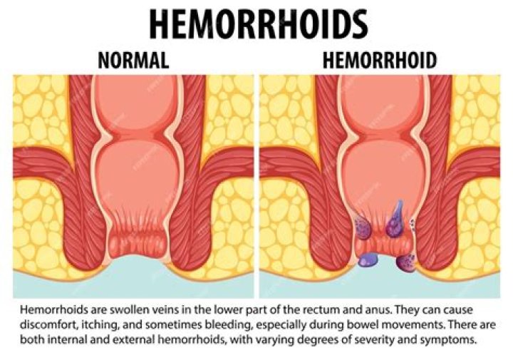 What is a large hemorrhoid?