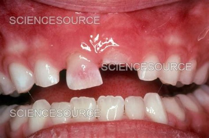 What is a pink tooth?