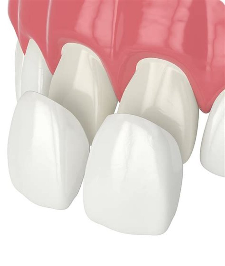 What is a porcelain veneer?