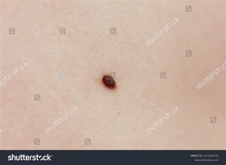 What is a precancerous mole?