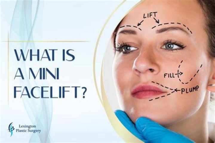 What is a silent facelift?