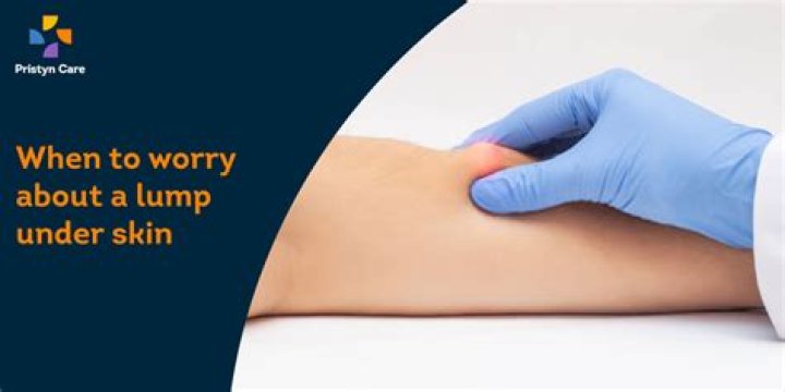 What is a soft lump under the skin?