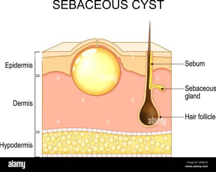 What is a squamous cyst?