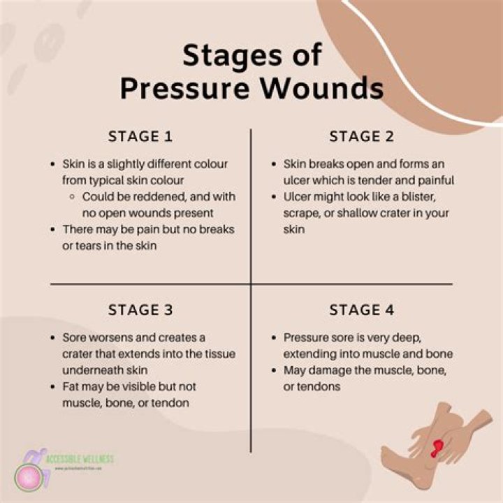 What is a stage 4 pressure wound?