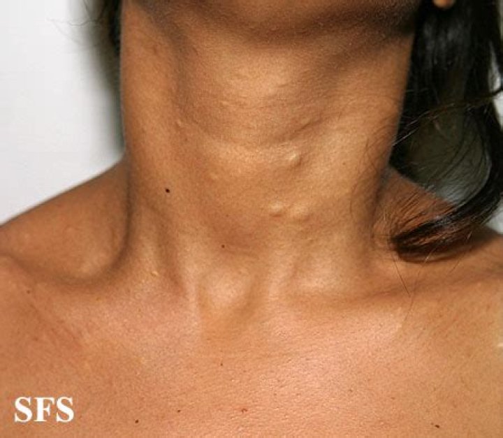 What is a Steatocystoma?